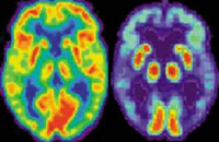 Биомаркеры заболевания Альцгеймера проявляются за 20 лет до первых симптомов