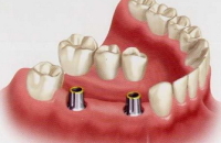 Имплантиция и протезирование зубов — СитиСмайл
