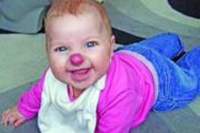 Необычная опухоль сделала из девочки настоящего клоуна Необычная опухоль сделала из девочки настоящего клоуна