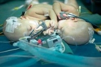 Китайские врачи успешно разделили сиамских близнецов Китайские врачи успешно разделили сиамских близнецов