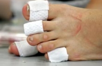 Липосакция пальцев ног опережает по популярности стандартные процедуры