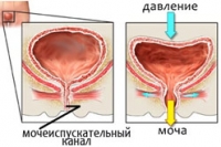 Недержание мочи у женщин Недержание мочи у женщин