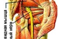 Невропатия седалищного нерва. Синдром грушевидной мышцы