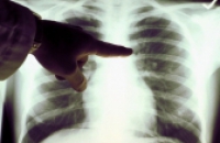 Дыхательный тест поможет выявить злокачественность рака легкого