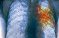 Ученые узнали, почему непросто вылечить туберкулез