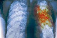 Ученые узнали, почему непросто вылечить туберкулез Ученые узнали, почему непросто вылечить туберкулез