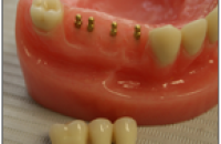 Стоит ли ставить зубные имплантаты?