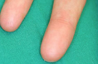 Эксперты выяснили, почему у некоторых людей нет отпечатков пальцев