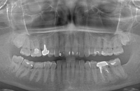 Ортопантомограмма. Снимок зубов перед протезированием