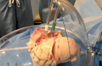 Трансплантологи научились доставлять пациенту донорские органы «живыми»