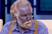 Из-за неправильного лечения дерматита американец получил фиолетовую окраску