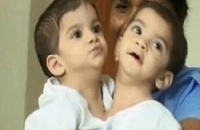 Еще одних сиамских близнецов успешно разделили в Индии