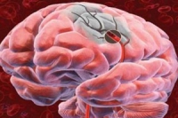 Травма мозга может проходить бессимптомно