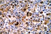 Препарат для лечения рака лимфатической системы Adcetris одобрен FDA Препарат для лечения рака лимфатической системы Adcetris одобрен FDA