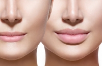 Особенности контурной пластики носа