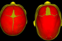 Найдены генетические причины врожденной деформации черепа