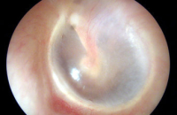 Ученые испытали устройство для мгновенного выявления инфекций среднего уха