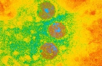 Рассеянный склероз вызван вирусом герпеса, предупреждают исследователи