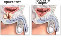 Профилактика заболеваний простаты Профилактика заболеваний простаты