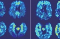Разработанная в США методика позволит предсказать развитие болезни Альцгеймера