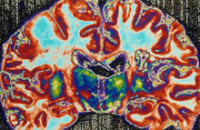 Размер мозжечка и риск развития шизофрении связаны