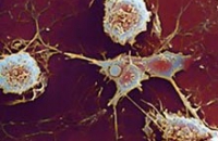 Рассеянный склероз и редкая генетическая аномалия связаны