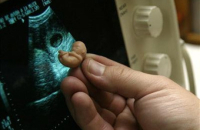 Минздрав сократил перечень показаний для проведения бесплатных абортов