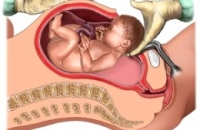 Запланированное кесарево сечение вредит ребенку