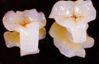 Циркониевые коронки для зубов снижают вероятность кариеса