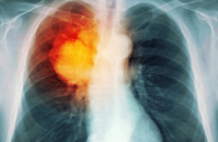 Геномный анализ объяснил предрасположенность некурящих азиаток к раку легких
