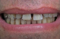 Поход к стоматологу закончился тремя операциями для пациентки