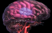 Черепно-мозговые травмы повышают риск инсульта