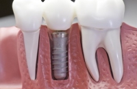 Имплантация зубов – не роскошь, а необходимость