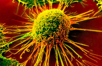 Новое в онкологии: электрошокером – по раковой опухоли