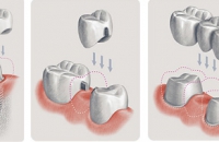 Стратегия замещения утрачиваемых зубов