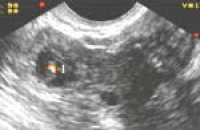 Сыворотка определяет внематочную беременность
