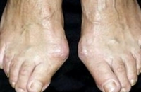 Генетика определяет вероятность появления деформаций пальцев ног